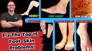 Top 15 Foot Skin Problems [Toenail Fungus, Dry Skin & More]