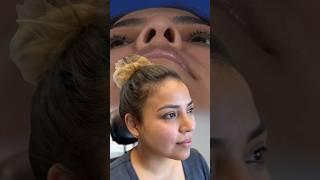 Rhinoplasty  Dr Daria Hamrah