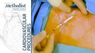 Tunneled Dialysis Catheter (TDC) Removal (Eric K. Peden, MD, M. Mujeeb Zubair, MD)