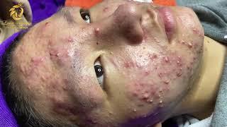 Treatment of acne tablets, pustules and blackheads (358) | Loan Nguyen