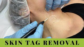 Skin Tags Removal on Neck and Underarms. Quick, easy, no pain.