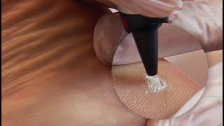 Plantar Wart Treatment