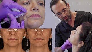 Treating Smile Lines & Marionette Lines with Revanesse Versa | Dr. Kian Karimi