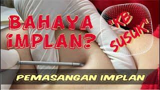 Pemasangan Implan / Susuk KB