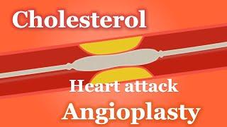 Angioplasty Heart attack cholesterol | learninginns