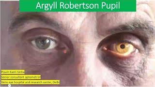 Pupil abnormality series lecture 4 :- Agryll robertson pupil VS adie's tonic pupil