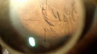 Laser peripheral iridotomy (LPI)