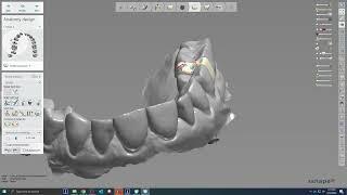 AnatotempSC - 3Shape Custom Abutment Design