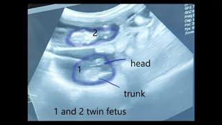 twin fetus or single by ultrasound determination in sheep and goat/sheep pregnency determination usg
