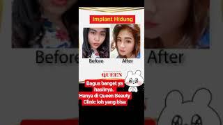 Implant Hidung di Queen Beauty Clinic Sunter Jakarta