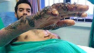 Can tilapia skin be used to bandage burns?