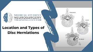 Location and Types of Disc Herniations