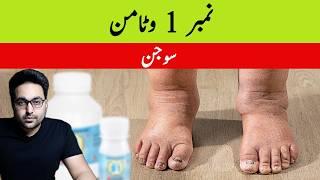 Dr. Zee:Top Vitamin to Eliminate Swollen Legs and Ankles | डॉक्टर ज़ी