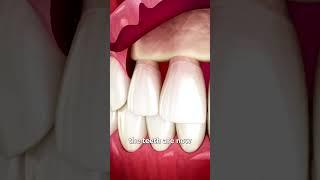 The Surgery To Reveal More Teeth 