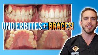 Underbite Braces Treatment W/ Rubber Bands! [BEFORE & AFTER]