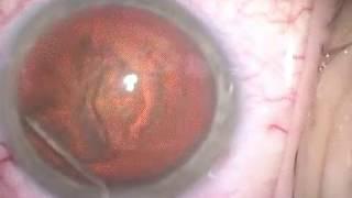 Cataract Surgery Horizontal Chop AMO Whitestar Signature by Jeffrey Huang, DO