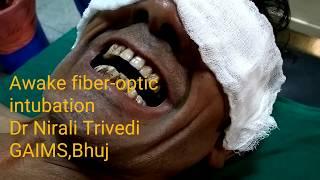 Awake fiberoptic intubation,(Video-bronchoscope has been used.)