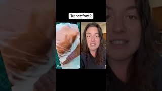 DUET REACTION trench foot skin peeling - Large foot blister from trenchfoot podiatry  - Jul 13, 2023