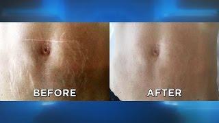 Does This Stretch Mark Removal Procedure Work?