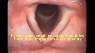 Vocal Folds Revealed