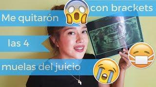 ME QUITARON LAS MUELAS DEL JUICIO / CORDALES  (Dia 1,2 y 4 ) Mi experiencia | COSTEÑITOS COATZA