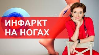 Инфаркт на ногах