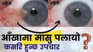 Aakhaa Maa Masu Plaune Rog Pterygium Ko Baremaa Jankari  | Growth of Fleshy Tissue In Eyes