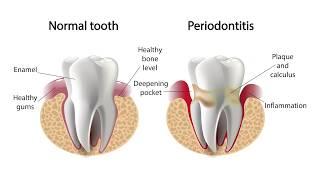 FAQ - What is periodontal disease? | Dental Designs by Quandt