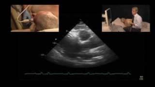 Measuring the Ascending Aorta Using Echocardiography