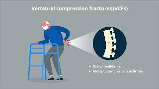 Elderly patients already dependent on care are more likely to have a functional decline after Verteb