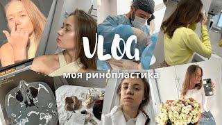 Ринопластика. VLOG//моя история. Как выбирала врача? Цена? ДО и ПОСЛЕ