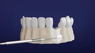 Step by Step Guide to Your Dental Implant Procedure