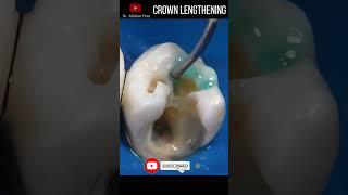 Crown lengthening in 4K