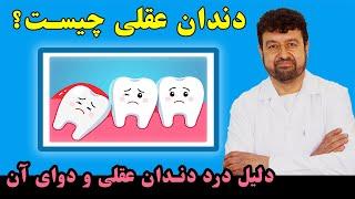 دندان عقلی چیست و کدام ها است | چرا دندان عقل زیاد درد میکند و کدام دواها برای درد دندان بهتر است 