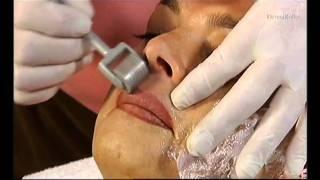 Dermaroller Collagen Induction Therapy