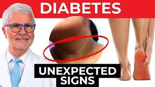 DO NOT IGNORE these Signs of Type 2 Diabetes | Dr. Gundry