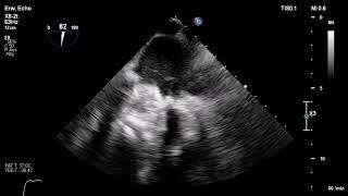 Mechanical Mitral Valve Prosthesis Thrombosis Thrombolytic Therapy