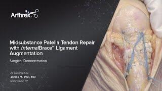 Midsubstance Patella Tendon Repair with InternalBrace™ Ligament Augmentation