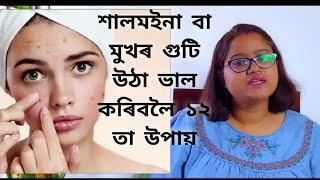 Acne বা মুখৰ গুটি ভাল কৰিবলৈ 12 তা Tips   || Dr. Ponkhi Sharma (PT)