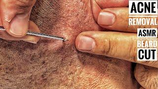 ASMR BEARD SHAVE And Subcutaneous acne removal • Barber Massage • Sleep Asmr