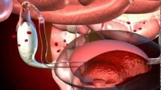 MyHEALTH : Endometriosis