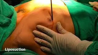 Man Boobs Surgery At Bliniq Cosmetic Surgery Centre I Dr. Ashwani Kumar Plastic Surgeon