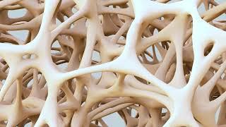 Osteoporosis Explained