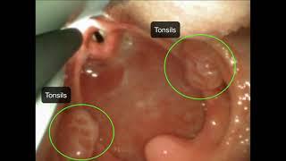 Laryngoscopy Education Video