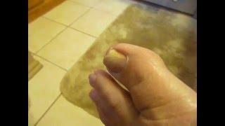 CURE FOOT / ToeNAIL FUNGUS Using Hydrogen Peroxide Soaks - Part 1