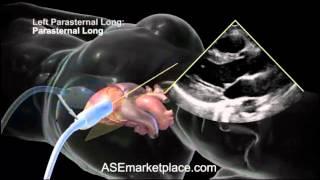 How to do a Basic Transthoracic Echocardiogram: Transducer Position and Anatomy