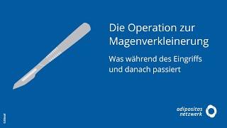 Die Operation zur Magenverkleinerung: Was während des Eingriffs und danach passiert