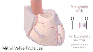 Mitral Valve Prolapse - sound & animation