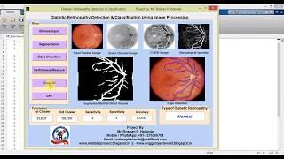 Diabetic Retinopathy Detection in Fundus Image Using Image Processing IEEE Based Project