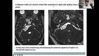 KULDEEP ASHWIN KAPDI | Pathologies of Trigeminal Nerve and MRI imaging  #mriteachingcourse